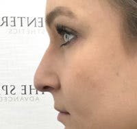 Non-Surgical Rhinoplasty / Nose Filler Before & After Gallery - Patient 310371 - Image 3