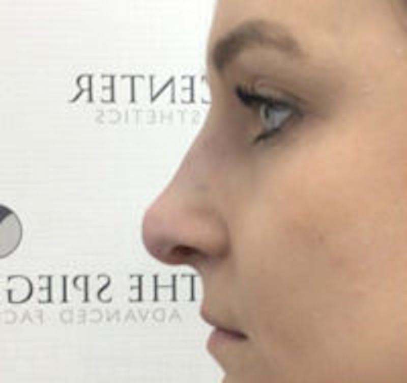 Non-Surgical Rhinoplasty / Nose Filler Before & After Gallery - Patient 310371 - Image 4