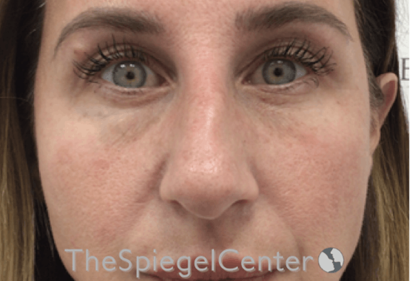 Non-Surgical Rhinoplasty / Nose Filler Before & After Gallery - Patient 312967 - Image 1