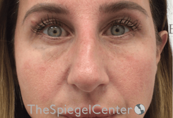 Non-Surgical Rhinoplasty / Nose Filler Before & After Gallery - Patient 312967 - Image 1