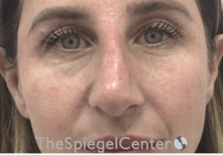 Non-Surgical Rhinoplasty / Nose Filler Before & After Gallery - Patient 312967 - Image 2