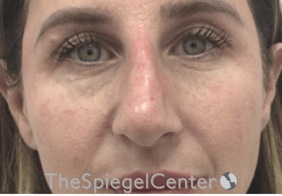 Non-Surgical Rhinoplasty / Nose Filler Before & After Gallery - Patient 312967 - Image 2