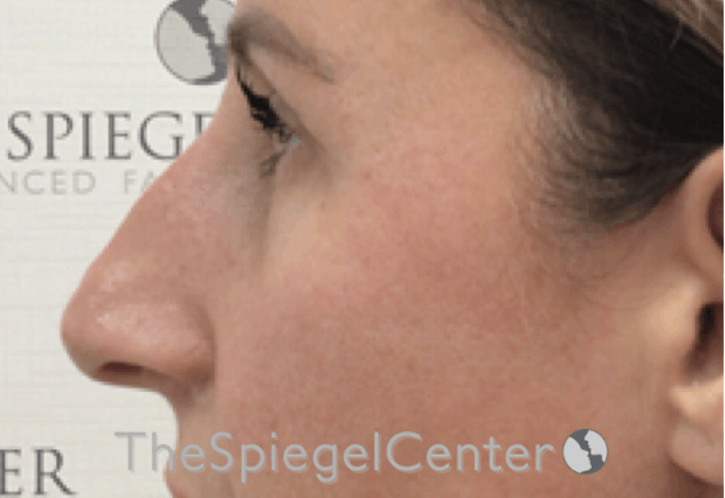 Non-Surgical Rhinoplasty / Nose Filler Before & After Gallery - Patient 312967 - Image 3