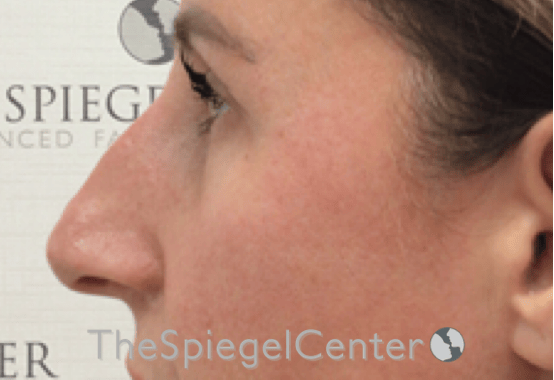 Non-Surgical Rhinoplasty / Nose Filler Before & After Gallery - Patient 312967 - Image 3