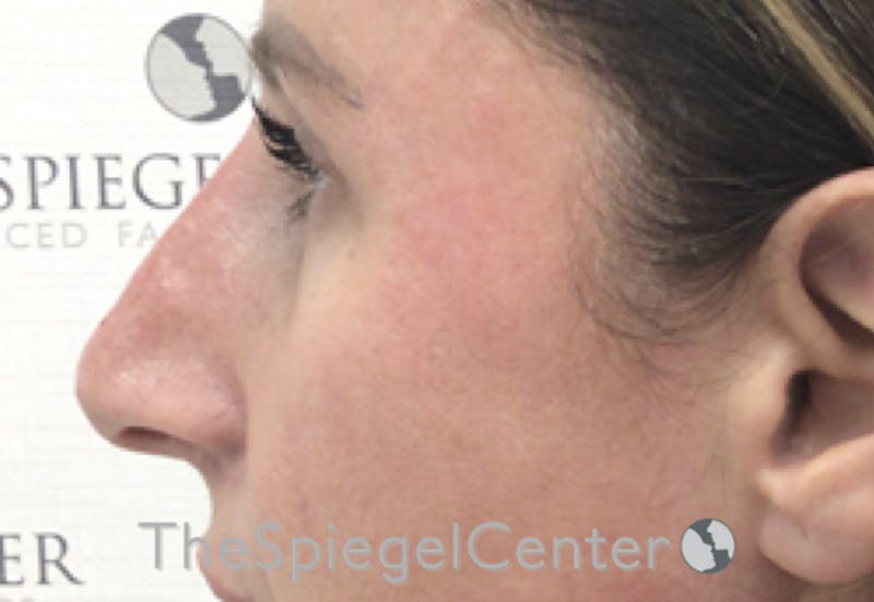 Non-Surgical Rhinoplasty / Nose Filler Before & After Gallery - Patient 312967 - Image 4