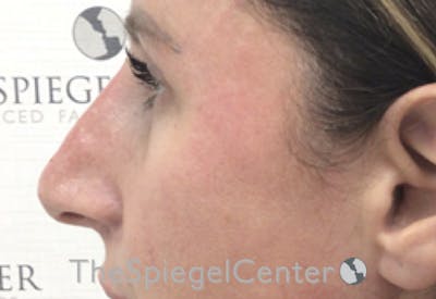 Non-Surgical Rhinoplasty / Nose Filler Before & After Gallery - Patient 312967 - Image 4