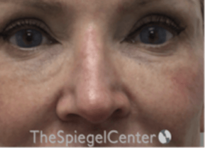Non-Surgical Rhinoplasty / Nose Filler Before & After Gallery - Patient 175249 - Image 1