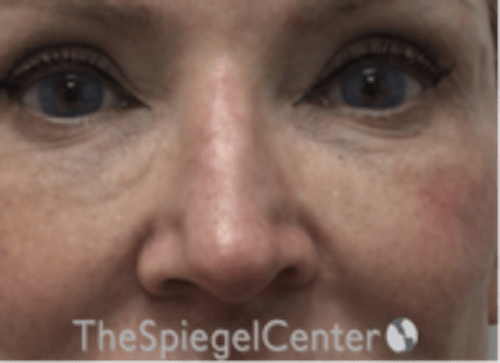Non-Surgical Rhinoplasty / Nose Filler Before & After Gallery - Patient 175249 - Image 1