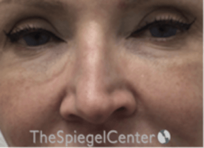 Non-Surgical Rhinoplasty / Nose Filler Before & After Gallery - Patient 175249 - Image 2