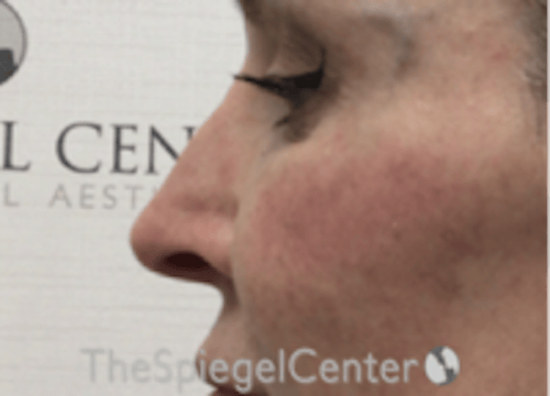 Non-Surgical Rhinoplasty / Nose Filler Before & After Gallery - Patient 175249 - Image 4