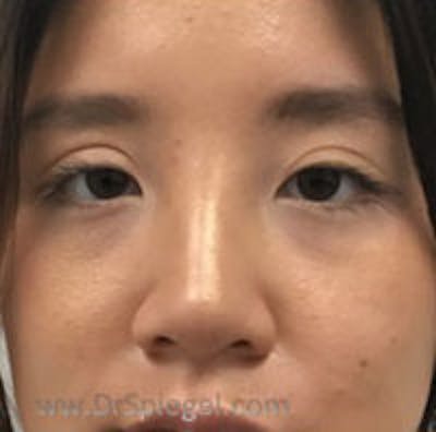 Non-Surgical Rhinoplasty Before & After Gallery - Patient 215781 - Image 2