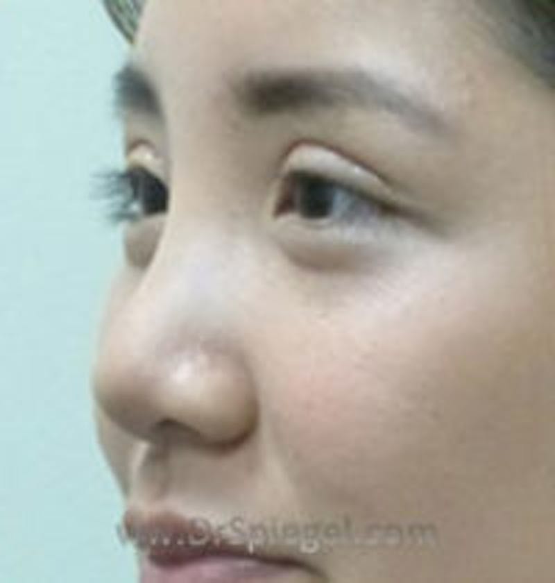 Non-Surgical Rhinoplasty / Nose Filler Before & After Gallery - Patient 101026 - Image 3