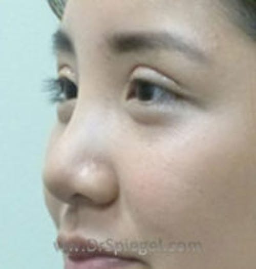 Non-Surgical Rhinoplasty Before & After Gallery - Patient 215781 - Image 3