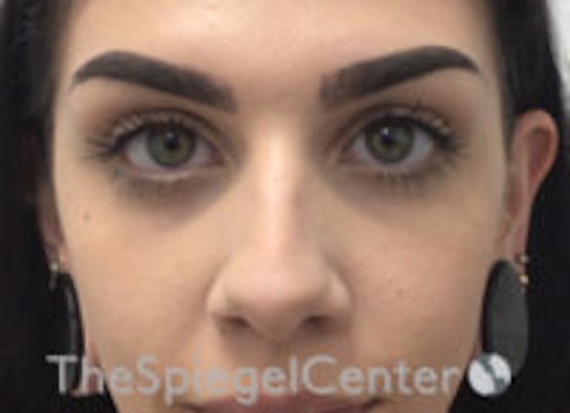 Non-Surgical Rhinoplasty / Nose Filler Before & After Gallery - Patient 116731 - Image 1