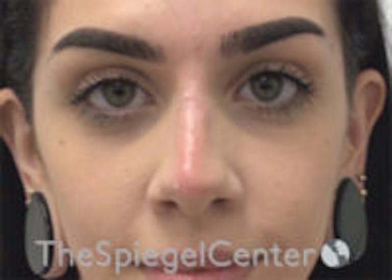 Non-Surgical Rhinoplasty / Nose Filler Before & After Gallery - Patient 116731 - Image 2
