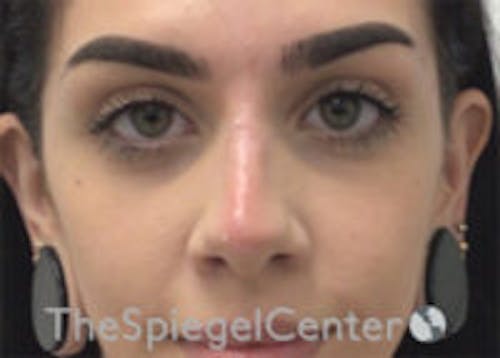 Non-Surgical Rhinoplasty / Nose Filler Before & After Gallery - Patient 116731 - Image 2
