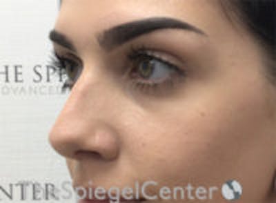 Non-Surgical Rhinoplasty / Nose Filler Before & After Gallery - Patient 116731 - Image 3