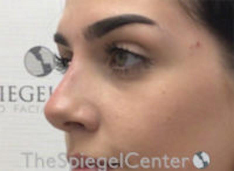 Non-Surgical Rhinoplasty / Nose Filler Before & After Gallery - Patient 116731 - Image 4