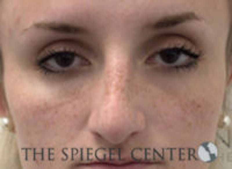Non-Surgical Rhinoplasty / Nose Filler Before & After Gallery - Patient 213543 - Image 1
