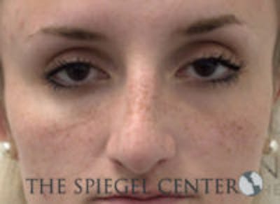Non-Surgical Rhinoplasty / Nose Filler Before & After Gallery - Patient 213543 - Image 1