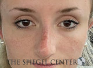 Non-Surgical Rhinoplasty / Nose Filler Before & After Gallery - Patient 213543 - Image 2