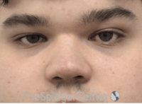Non-Surgical Rhinoplasty / Nose Filler Before & After Gallery - Patient 589780 - Image 1