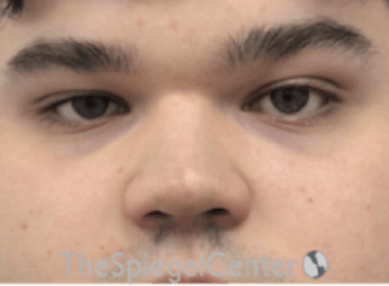 Non-Surgical Rhinoplasty / Nose Filler Before & After Gallery - Patient 589780 - Image 1