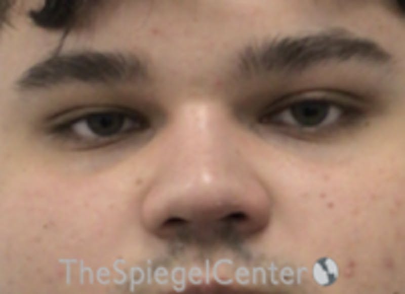 Non-Surgical Rhinoplasty / Nose Filler Before & After Gallery - Patient 589780 - Image 2