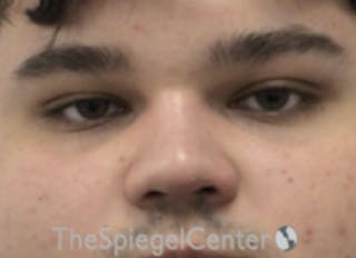 Non-Surgical Rhinoplasty / Nose Filler Before & After Gallery - Patient 589780 - Image 2