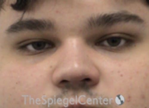 Non-Surgical Rhinoplasty / Nose Filler Before & After Gallery - Patient 589780 - Image 2