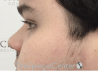 Non-Surgical Rhinoplasty / Nose Filler Before & After Gallery - Patient 589780 - Image 3
