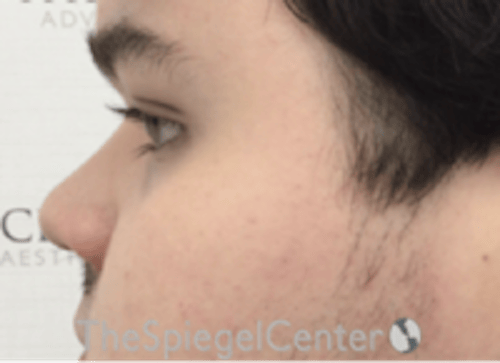 Non-Surgical Rhinoplasty / Nose Filler Before & After Gallery - Patient 589780 - Image 3