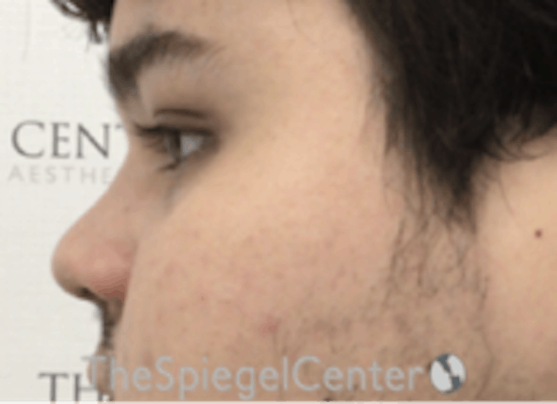 Non-Surgical Rhinoplasty / Nose Filler Before & After Gallery - Patient 589780 - Image 4