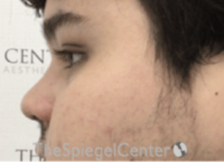 Non-Surgical Rhinoplasty / Nose Filler Before & After Gallery - Patient 589780 - Image 4