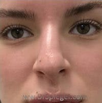 Non-Surgical Rhinoplasty / Nose Filler Before & After Gallery - Patient 240418 - Image 1