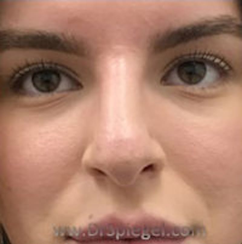 Non-Surgical Rhinoplasty / Nose Filler Before & After Gallery - Patient 240418 - Image 2