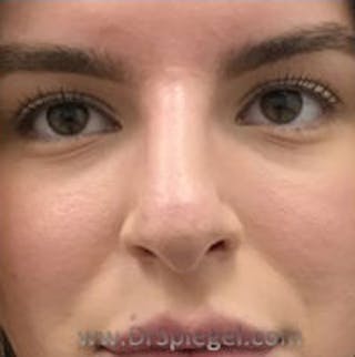 Non-Surgical Rhinoplasty / Nose Filler Before & After Gallery - Patient 240418 - Image 2