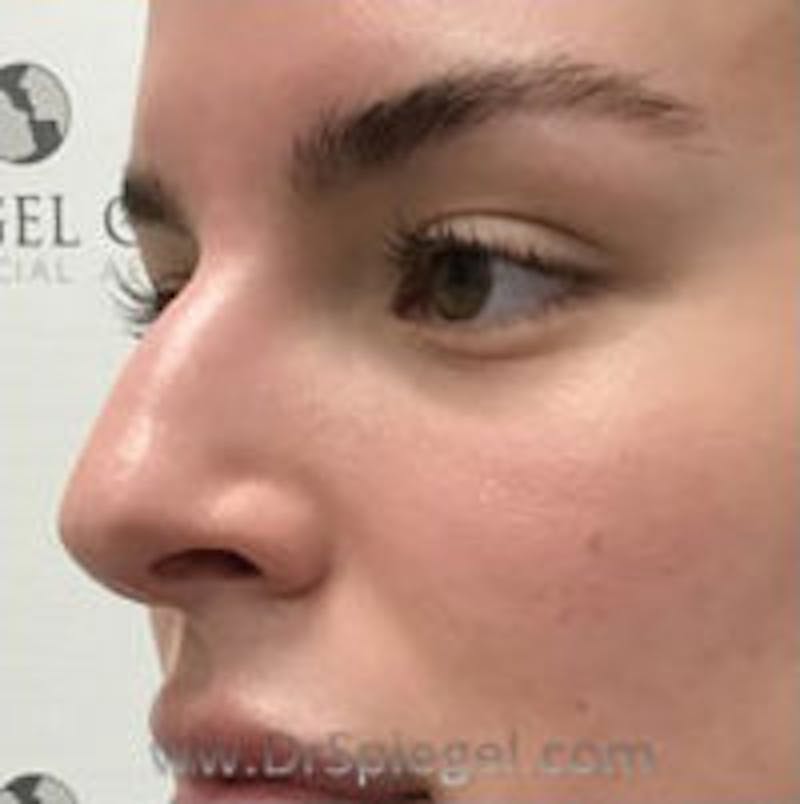 Non-Surgical Rhinoplasty / Nose Filler Before & After Gallery - Patient 240418 - Image 3
