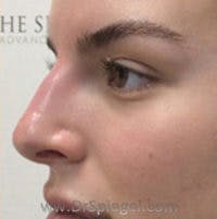 Non-Surgical Rhinoplasty / Nose Filler Before & After Gallery - Patient 240418 - Image 4
