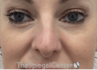 Non-Surgical Rhinoplasty / Nose Filler Before & After Gallery - Patient 258538 - Image 1