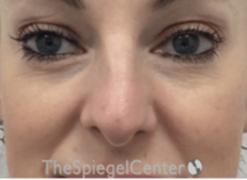 Non-Surgical Rhinoplasty / Nose Filler Before & After Gallery - Patient 258538 - Image 1