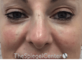 Non-Surgical Rhinoplasty / Nose Filler Before & After Gallery - Patient 258538 - Image 2