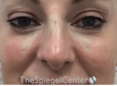 Non-Surgical Rhinoplasty / Nose Filler Before & After Gallery - Patient 258538 - Image 2