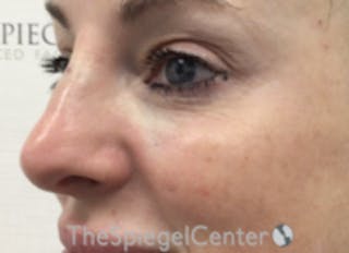 Non-Surgical Rhinoplasty / Nose Filler Before & After Gallery - Patient 258538 - Image 4