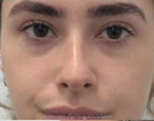 Non-Surgical Rhinoplasty / Nose Filler Before & After Gallery - Patient 382023 - Image 1