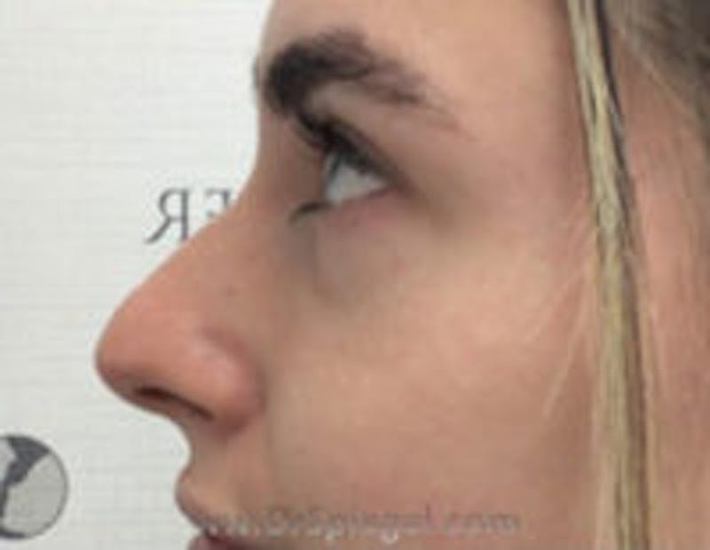 Non-Surgical Rhinoplasty / Nose Filler Before & After Gallery - Patient 382023 - Image 3