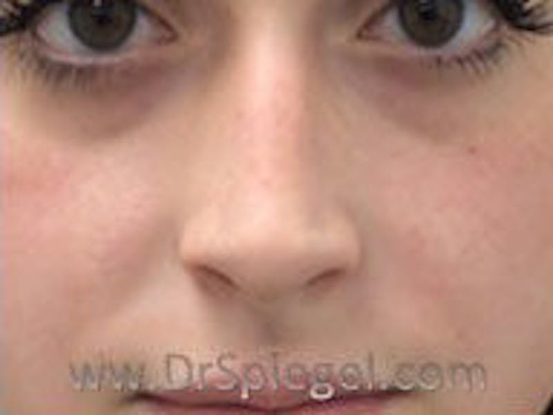 Non-Surgical Rhinoplasty / Nose Filler Before & After Gallery - Patient 104554 - Image 1