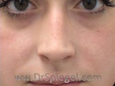 Non-Surgical Rhinoplasty / Nose Filler Before & After Gallery - Patient 104554 - Image 1