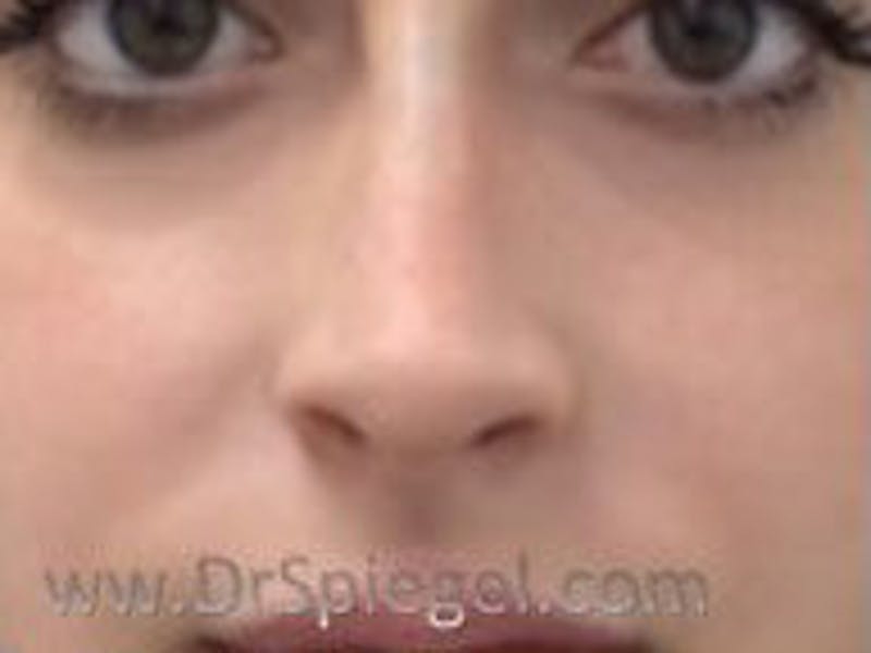 Non-Surgical Rhinoplasty / Nose Filler Before & After Gallery - Patient 104554 - Image 2