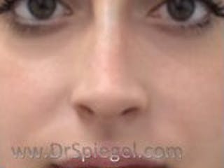 Non-Surgical Rhinoplasty / Nose Filler Before & After Gallery - Patient 104554 - Image 2